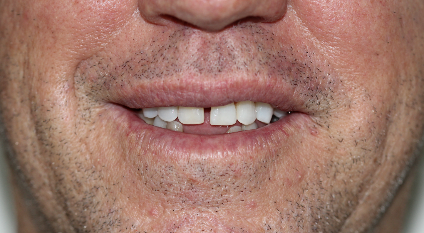 Sorriso do paciente antes do tratamento (resultado 2)