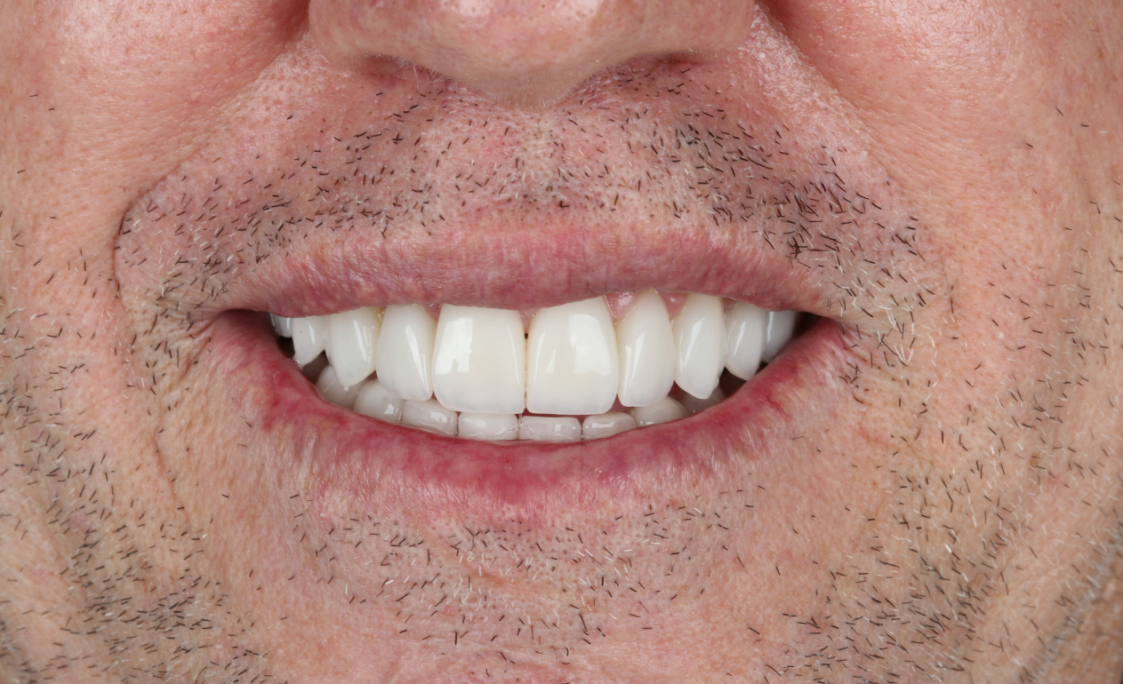 Sorriso do paciente depois do tratamento (resultado 2)