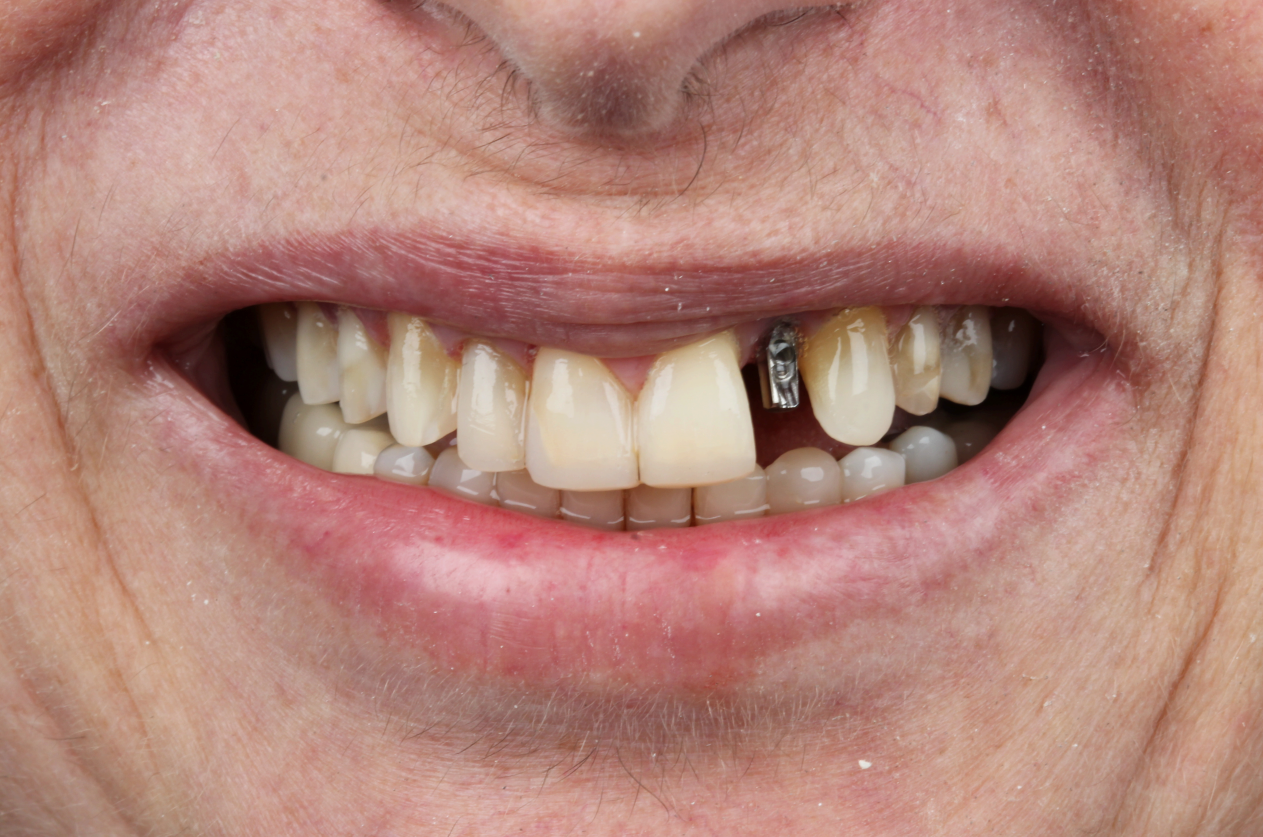 Sorriso do paciente antes do tratamento (resultado 3)