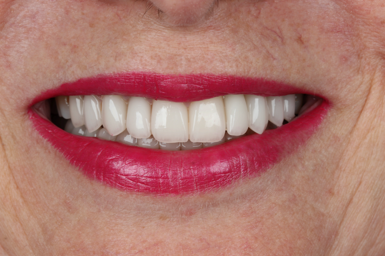 Sorriso do paciente depois do tratamento (resultado 3)