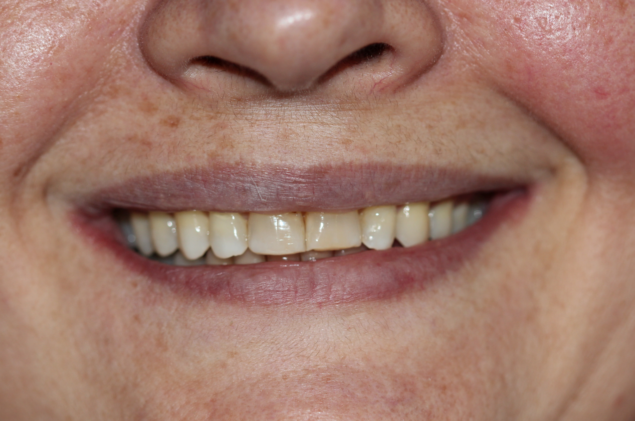 Sorriso do paciente antes do tratamento (resultado 4)