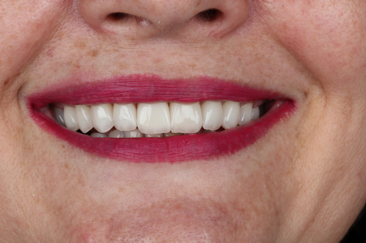 Sorriso do paciente depois do tratamento (resultado 4)